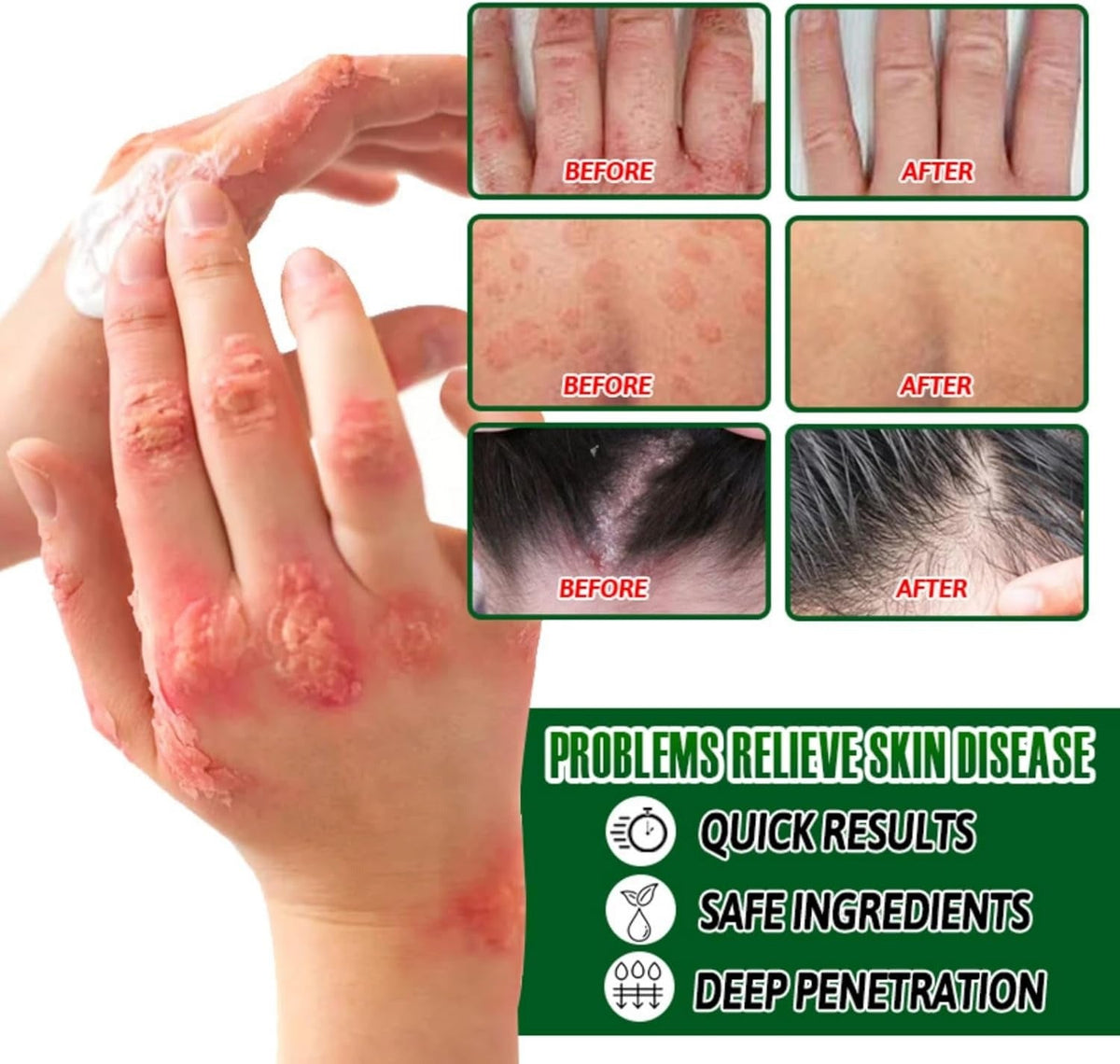 Psoriasis Cream (Original) – 20g