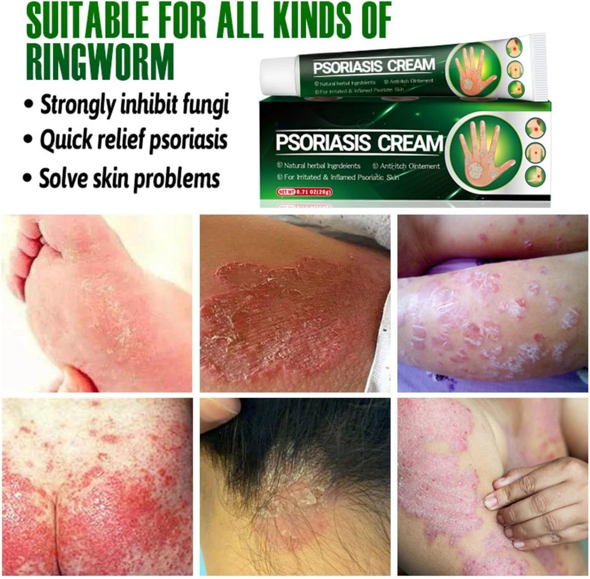 Psoriasis Cream (Original) – 20g